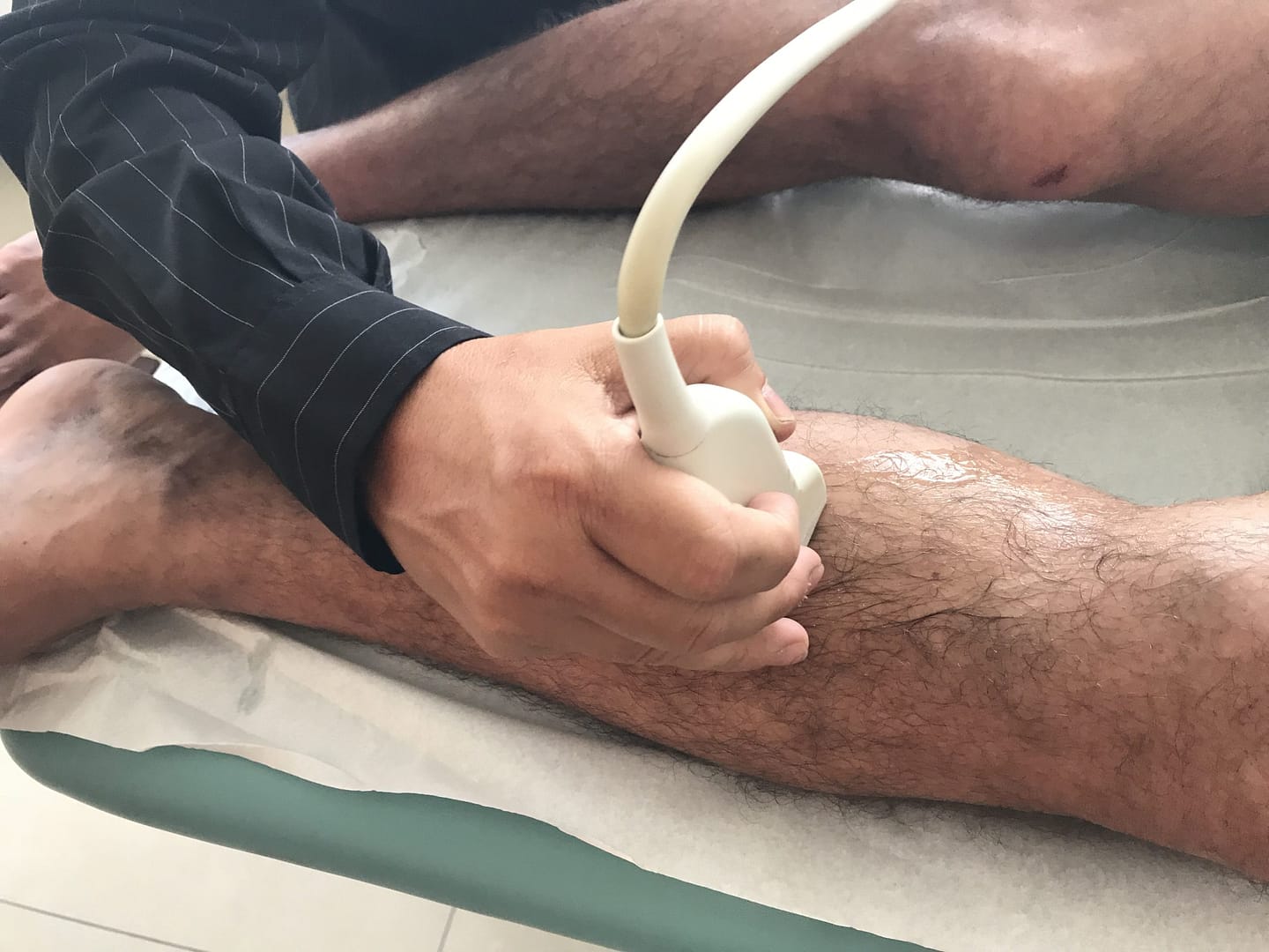 ESCLEROTERAPIA COM ESPUMA 1